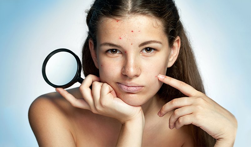 Angiomas de cereza, ¿son síntomas de algo grave?